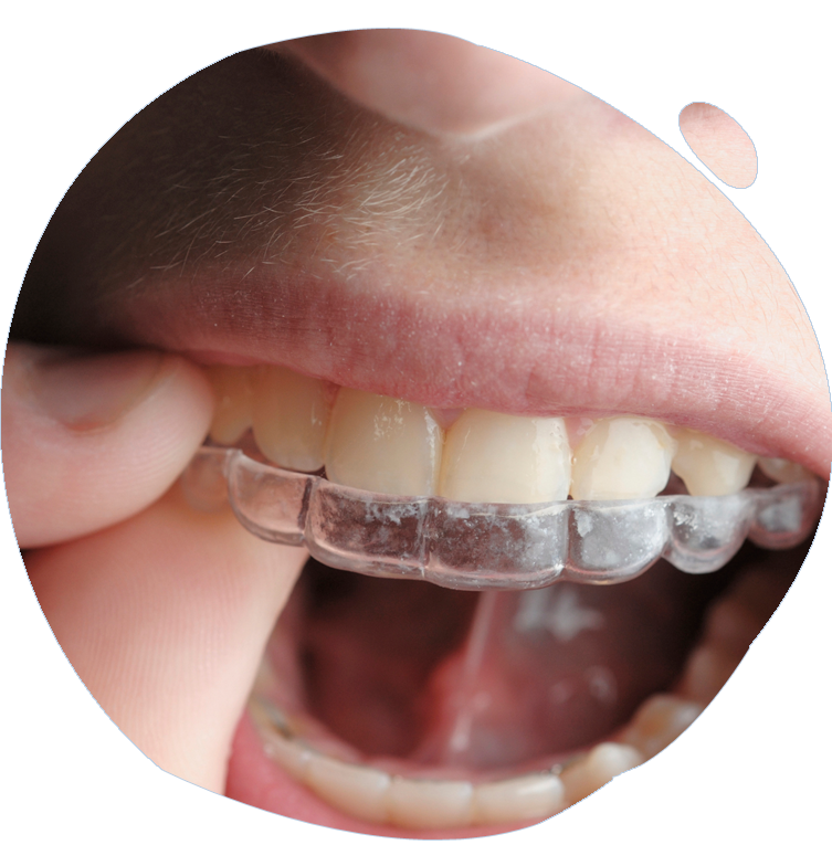 https://www.magizhchidental.in/wp-content/uploads/2021/02/Invisalign-1.png