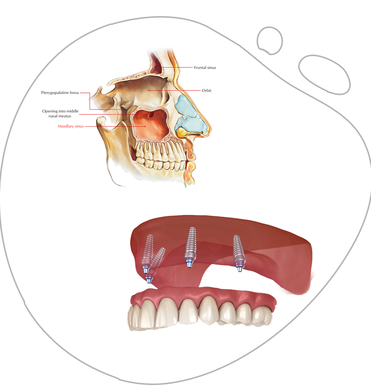 https://www.magizhchidental.in/wp-content/uploads/2021/02/all-on-4.png