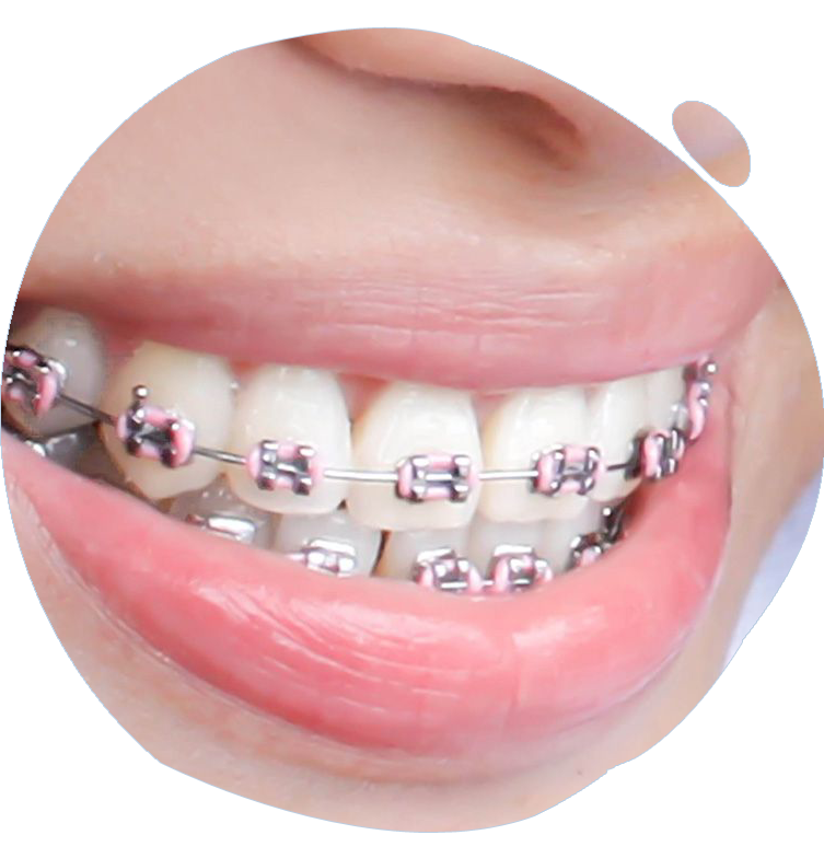 how do braces work