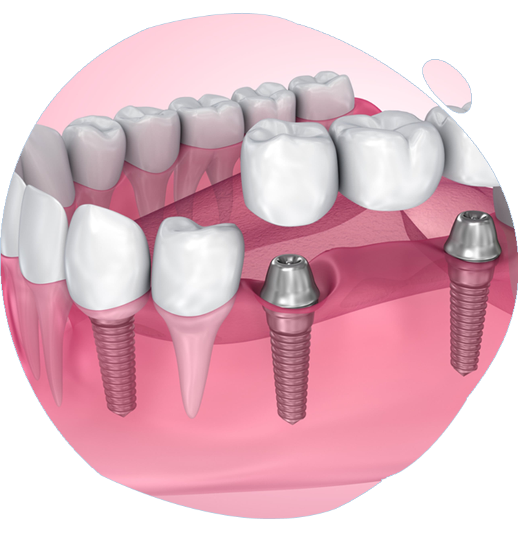 https://www.magizhchidental.in/wp-content/uploads/2021/02/dd-img.png