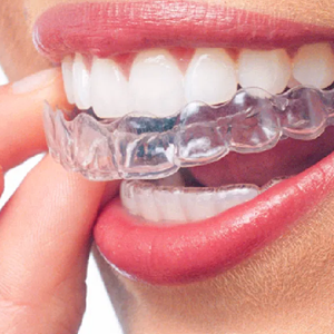 One week to ten days after the trial fit. Patient need not be present. The clear aligners can be shipped to you place.