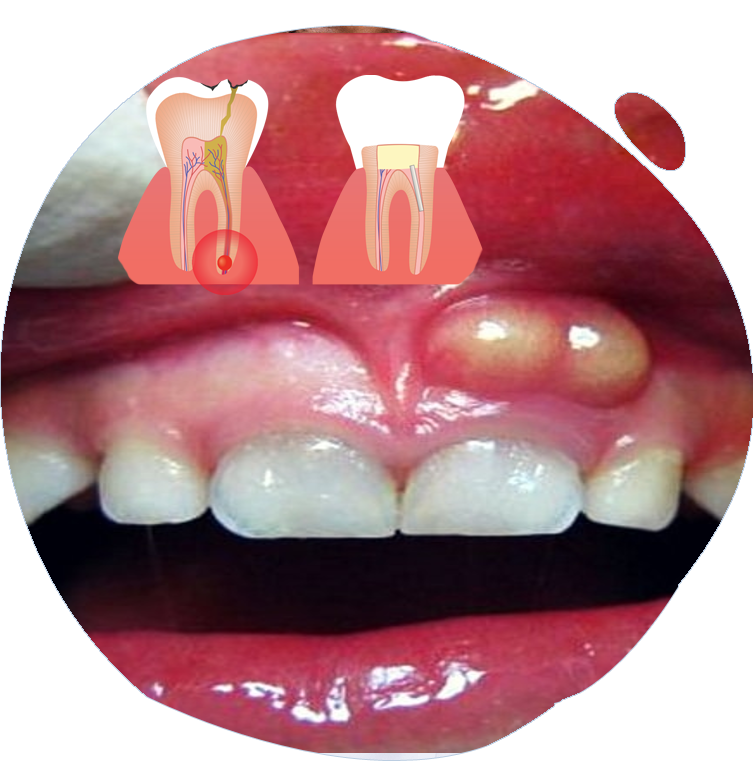 https://www.magizhchidental.in/wp-content/uploads/2021/02/root-canal-1.png