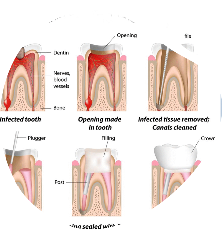 https://www.magizhchidental.in/wp-content/uploads/2021/02/root-canal-2.png