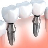 Dental Implant cost