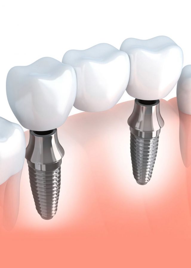 Dental Implant cost 399$