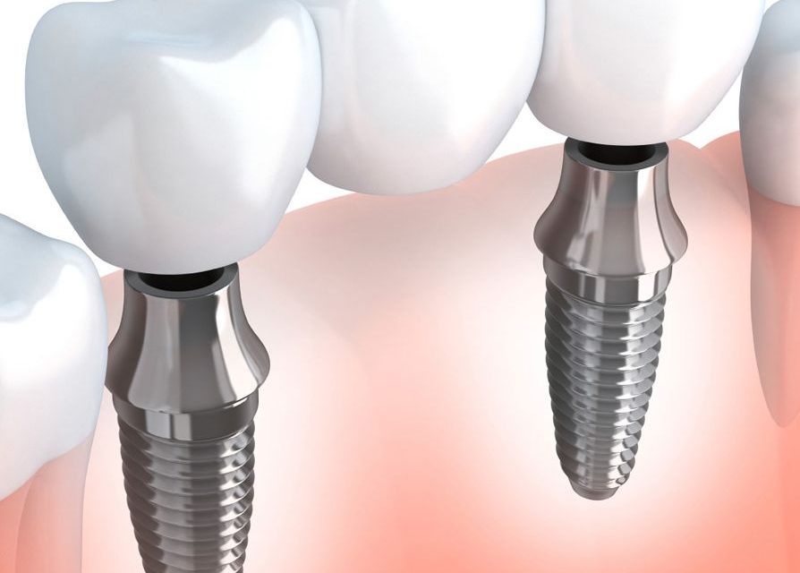 Dental Implant Cost and Treatment Plan