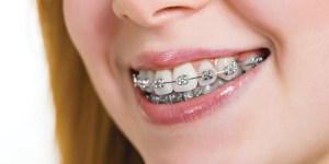 கிளிப் சிகிச்சை/ Braces in Tamil