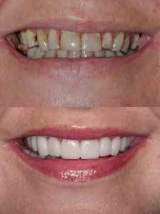 https://www.magizhchidental.in/wp-content/uploads/2021/03/2-before-and-after-veneers.jpg