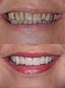 Dental Veneer