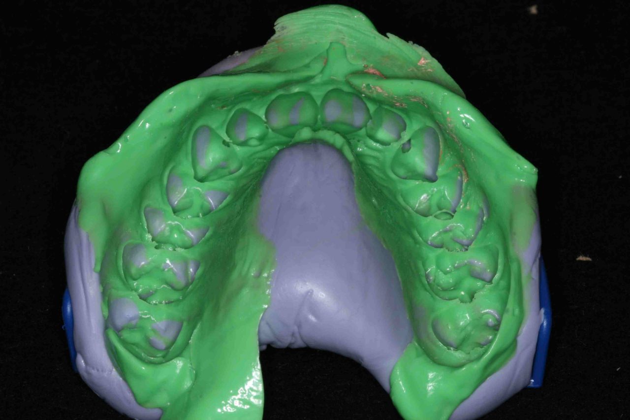 clear aligners madurai