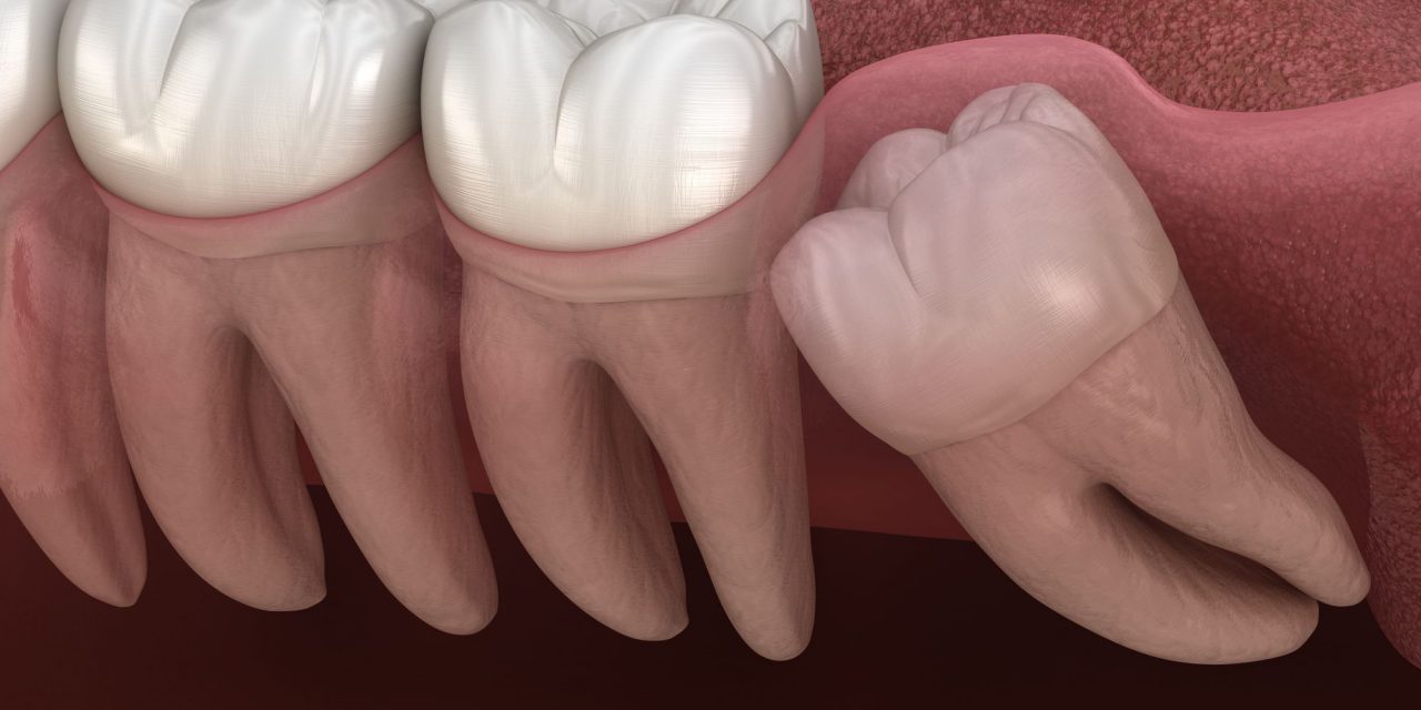 What is Wisdom tooth / Wisdom teeth pain