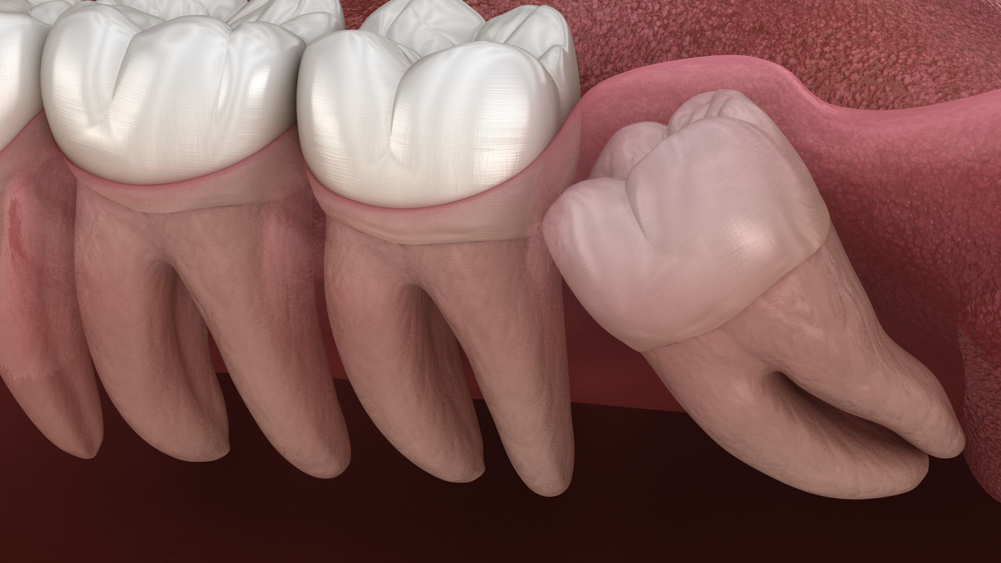 Symptoms and indicators of an impacted tooth