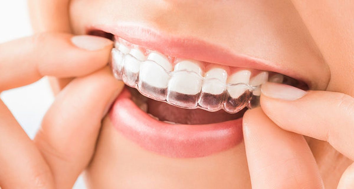 Teeth Aligners in Tamil/ Invisalign cost madurai