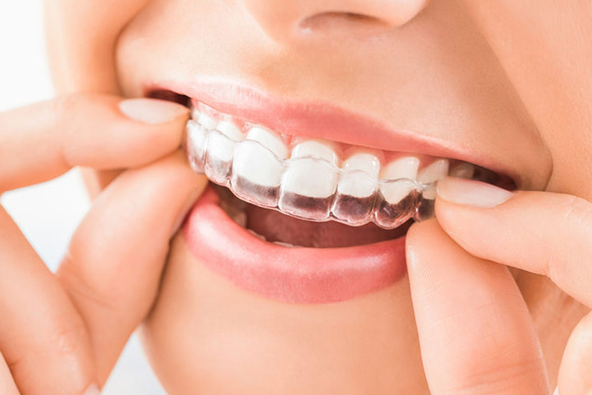 invisalign madurai