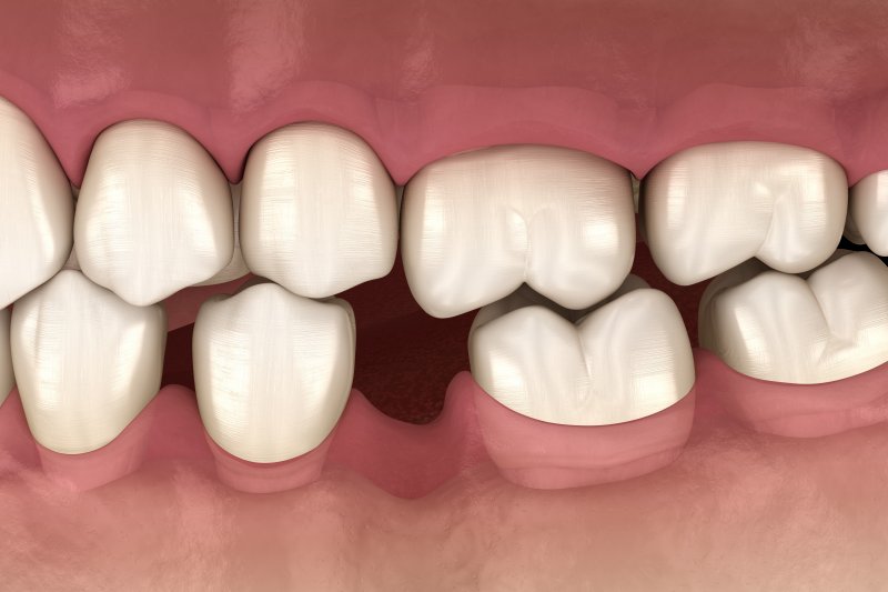 Does Invisalign move back teeth first?