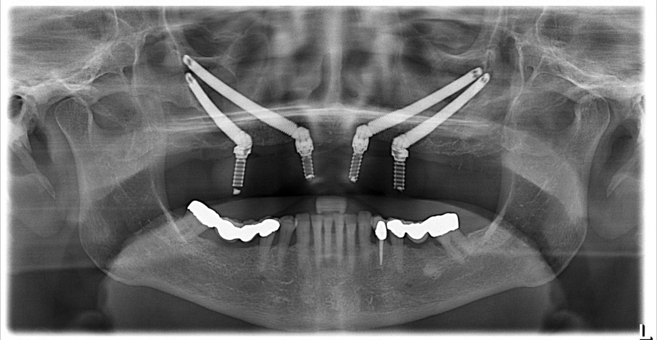 zygoma implants