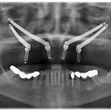 zygoma implants