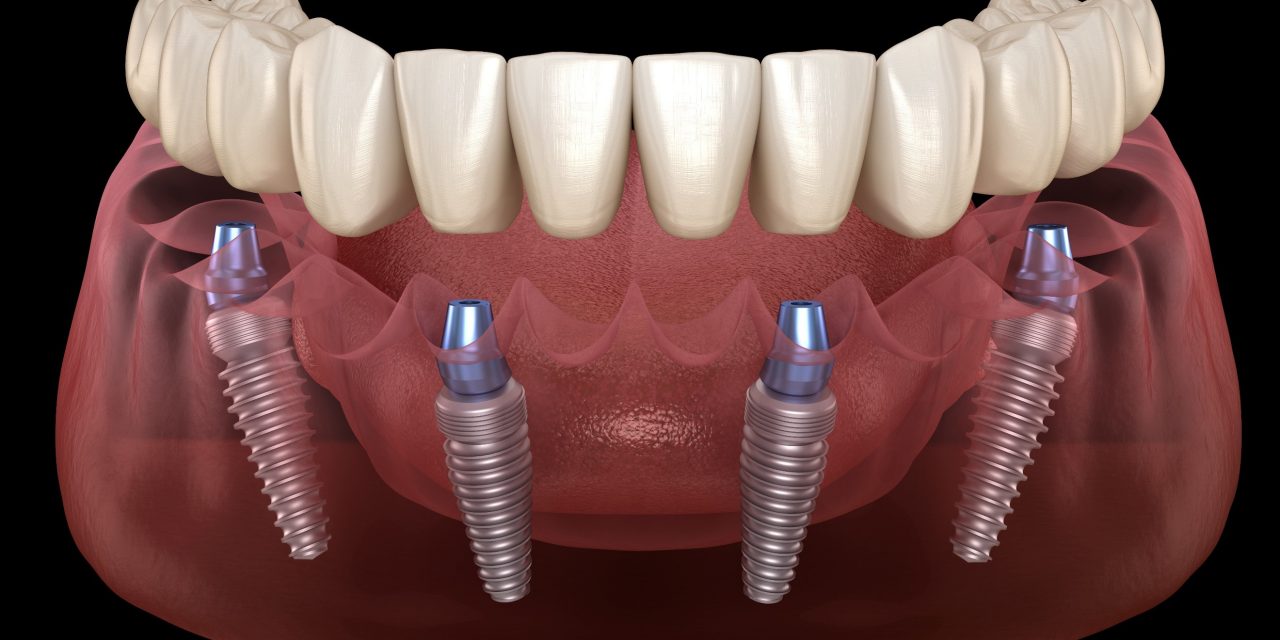 All on 4 Implant Treatment