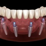 All on 4 implant