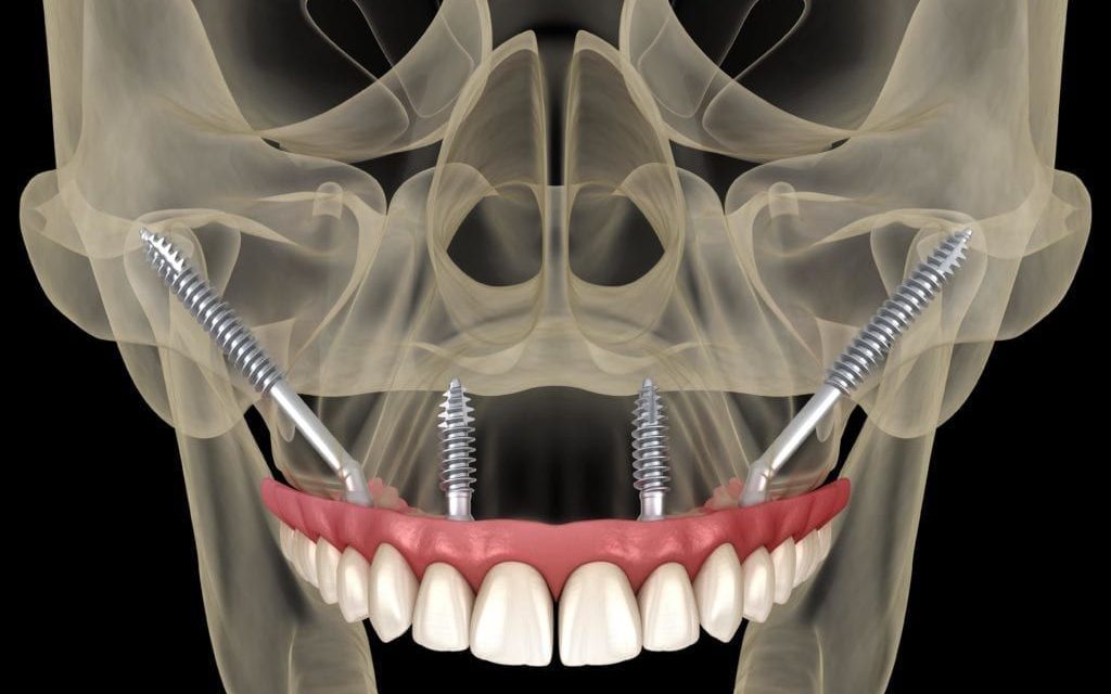 Zygoma Implants- Treatment procedure and cost