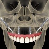 zygoma implants