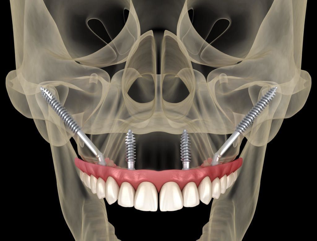 zygoma implants