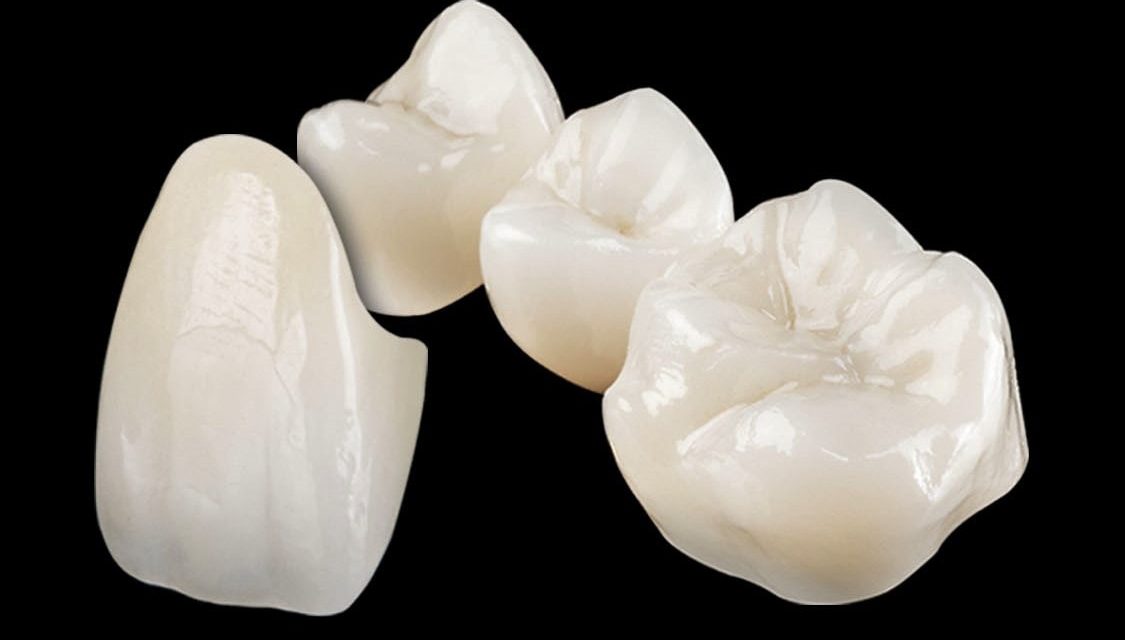 What are the types and Cost of Dental Crowns