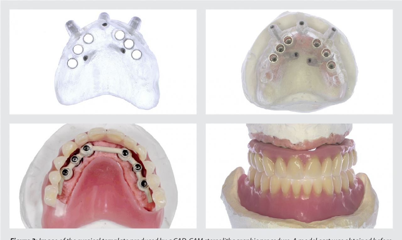 Guided Implant Surgery