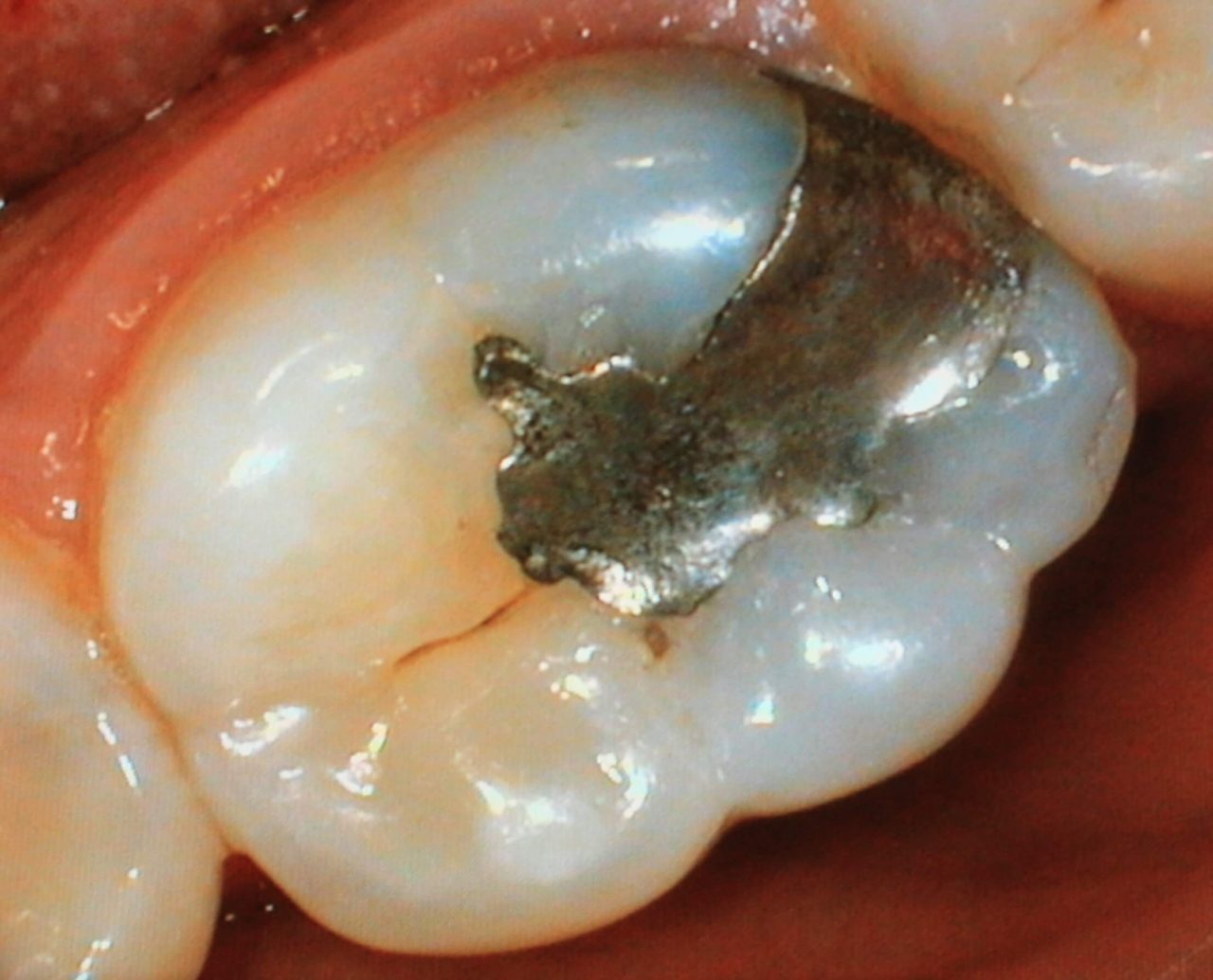 amalgam filling