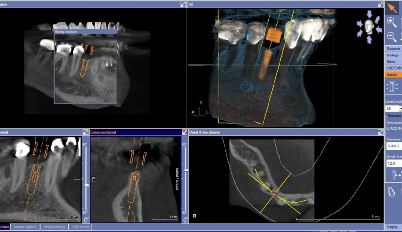 Guided Implant Surgery