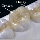 Tooth inlay