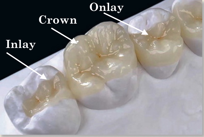 Tooth inlay