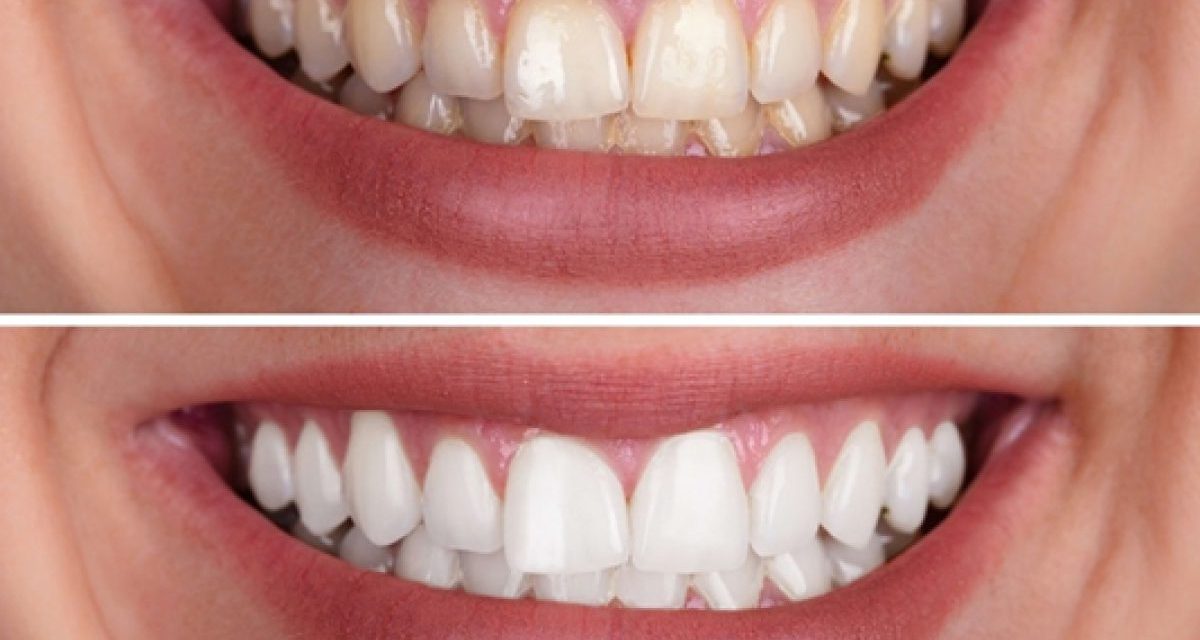 Teeth Bleaching