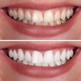 teeth bleaching