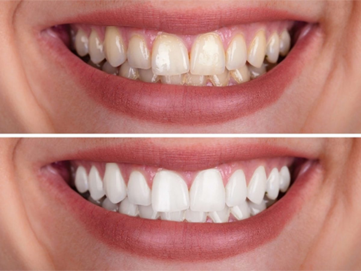 teeth bleaching