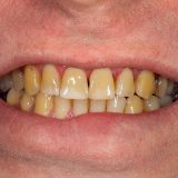 smoking, plaque on teeth



human teeth after smoking. Brown resinous plaque on teeth close-up. Smoking harm concept