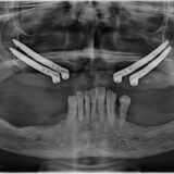 zygomatic implant magizhchidental