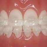 ceramicbraces