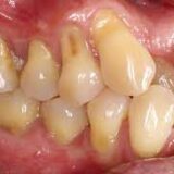 gingival recession