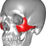 zygomatic bone