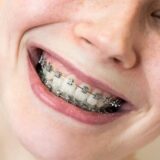 metal braces 2