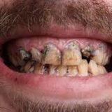 poor oral hygiene