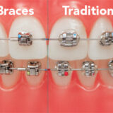 traditional vs damon braces