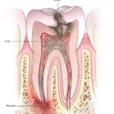A pocket of pus at the tip of the tooth root-Tooth abscess - Symptoms & causes - Mayo Clinic