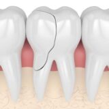 Cracked Teeth Causes and Treatment - West Hollywood Holistic and Cosmetic Dental Care