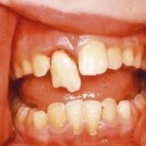Dental Trauma – A Quick Guide for Parents