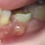 How to Pop a Dental Abscess by Yourself (and Why It's Risky)