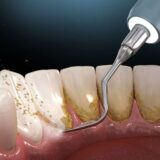 Oral hygiene: Ultrasonic teeth cleaning machine removing calculus and plaque. Medically accurate 3D illustration of human teeth treatment