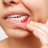 What Is A Periodontal Disease_
