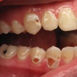 caries progression